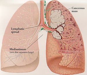 Lung Cancer diagram