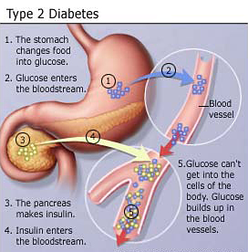 Type 2 diabetes diagram